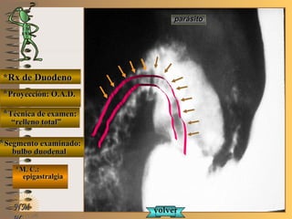 E ME M
UNTUNT
*Rx de Duodeno*Rx de Duodeno
**Proyección: O.A.D.Proyección: O.A.D.
**Técnica de examen:Técnica de examen:
““relleno total”relleno total”
**Segmento examinado:Segmento examinado:
bulbo duodenalbulbo duodenal
*M. C.:*M. C.:
epigastralgiaepigastralgia
NMNM
parásitoparásito
volvervolver
 