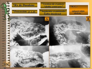 BBAA
*Rx de Duodeno*Rx de Duodeno
**Proyección:Proyección:
**Técnica de examen:Técnica de examen:
**Segmento examinado:Segmento examinado:
NMNM
N
E ME M
UNTUNT
*M. C.:*M. C.:
epigastralgiaepigastralgia
melenamelenaO.A.D.O.A.D.
““doble contraste”doble contraste”
bulbo duodenalbulbo duodenal
 