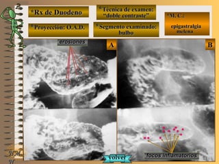 BBAA
**Proyección: O.A.D.Proyección: O.A.D.
NMNM
N
E ME M
UNTUNT
*M. C.:*M. C.:
epigastralgiaepigastralgia
melenamelena
*Rx de Duodeno*Rx de Duodeno **Técnica de examen:Técnica de examen:
““doble contraste”doble contraste”
**Segmento examinado:Segmento examinado:
bulbobulbo
erosioneserosiones
focos inflamatoriosfocos inflamatoriosvolvervolver
 