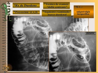 *Rx de Duodeno*Rx de Duodeno
**Proyección:Proyección:
**Técnica de examen:Técnica de examen:
**Segmento examinado:Segmento examinado:
NMNM
N
E ME M
UNTUNT
*M. C.:*M. C.:
epigastralgiaepigastralgia
inespecíficainespecífica
detalledetalle
O.A.D.O.A.D.
““doble contraste”doble contraste”
marco duodenalmarco duodenal
 