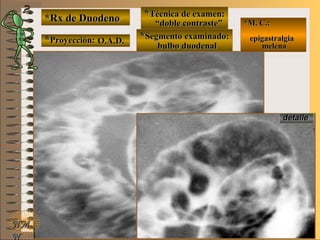 detalledetalle
*Rx de Duodeno*Rx de Duodeno
**Proyección:Proyección:
**Técnica de examen:Técnica de examen:
**Segmento examinado:Segmento examinado:
NMNM
N
E ME M
UNTUNT
*M. C.:*M. C.:
epigastralgiaepigastralgia
melenamelena
O.A.D.O.A.D.
““doble contraste”doble contraste”
bulbo duodenalbulbo duodenal
 