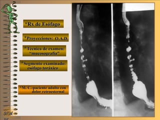 E ME M
UNTUNT
NMNM
*Rx de Esófago*Rx de Esófago
**Proyecciones:Proyecciones:
**Técnica de examen:Técnica de examen:
**Segmento examinado:Segmento examinado:
*M. C.:paciente adulto con*M. C.:paciente adulto con
dolor retroesternaldolor retroesternal
O.A.D.O.A.D.
““mucosografía”mucosografía”
esófago toráxicoesófago toráxico
 