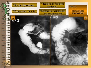 *Rx de Duodeno*Rx de Duodeno
**Proyección:Proyección:
**Técnica de examen:Técnica de examen:
**Segmento examinado:Segmento examinado:
NMNM
N
E ME M
UNTUNT
*M. C.:*M. C.:
epigastralgiaepigastralgia
inespecíficainespecífica
BBAA
O.A.D.O.A.D.
““relleno”relleno”
marco duodenalmarco duodenal
 