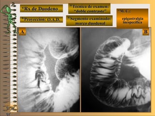 *Rx de Duodeno*Rx de Duodeno
**Proyección:Proyección:
**Técnica de examen:Técnica de examen:
**Segmento examinado:Segmento examinado:
NMNM
N
E ME M
UNTUNT
*M. C.:*M. C.:
epigastralgiaepigastralgia
inespecíficainespecífica
BBAA
O.A.D.O.A.D.
““doble contraste”doble contraste”
marco duodenalmarco duodenal
 
