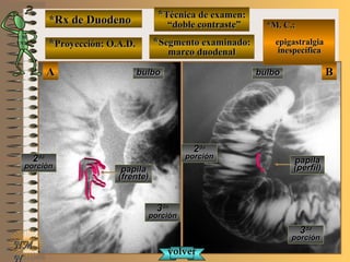 *Rx de Duodeno*Rx de Duodeno
**Proyección: O.A.D.Proyección: O.A.D.
**Técnica de examen:Técnica de examen:
““doble contraste”doble contraste”
**Segmento examinado:Segmento examinado:
marco duodenalmarco duodenal
NMNM
N
E ME M
UNTUNT
*M. C.:*M. C.:
epigastralgiaepigastralgia
inespecíficainespecífica
BBAA bulbobulbo
22dada
porciónporción22dada
porciónporción
33dada
porciónporción
33dada
porciónporción
papilapapila
(frente)(frente)
papilapapila
(perfil)(perfil)
volvervolver
bulbobulbo
 