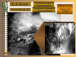 detalledetalle
*Rx de Duodeno*Rx de Duodeno
**Proyección:Proyección:
**Técnica de examen:Técnica de examen:
**Segmento examinado:Segmento examinado:
NMNM
N
E ME M
UNTUNT
*M. C.:*M. C.:
malestar gral.malestar gral.
melenamelena
O.A.D.O.A.D.
““mucosografía”mucosografía”
marco duodenalmarco duodenal
 