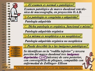 A-A-El examen es normal o patológico?El examen es normal o patológico?
Examen patológico de marco duodenal con téc-Examen patológico de marco duodenal con téc-
nica de mucosografía, en proyección O.A.D.nica de mucosografía, en proyección O.A.D.
B-B-La patología es congénita o adquirida?La patología es congénita o adquirida?
Patología adquiridaPatología adquirida
C-C- Dicha patología es orgánica, funcional o mixta?Dicha patología es orgánica, funcional o mixta?
**OpciónOpción
de volverde volver
a ver lasa ver las
imágenesimágenes
Patología adquirida orgánicaPatología adquirida orgánica
D-D-La misma es neoplásica o no neoplásica?La misma es neoplásica o no neoplásica?
Patología adquirida orgánica no neoplásicaPatología adquirida orgánica no neoplásica
E-E-Puede describir la o las imágenes patológicas?Puede describir la o las imágenes patológicas?
Se identifican en la “rodilla inferior” y terceraSe identifican en la “rodilla inferior” y tercera
porción del marco duodenal tresporción del marco duodenal tres imágenesimágenes
deprimidasdeprimidas UNTUNT (ulceras) de cara posterior,(ulceras) de cara posterior,
con convergencia de pliegues, compatible concon convergencia de pliegues, compatible con
enfermedad de Zollinger- Ellisonenfermedad de Zollinger- Ellison
**Opción avanzada para volver a ver las imágenes con reparosOpción avanzada para volver a ver las imágenes con reparosNMNM
D. F. M.D. F. M.
UNTUNT
E ME M
UNTUNT
 