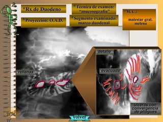 detalledetalle
*Rx de Duodeno*Rx de Duodeno
**Proyección: O.A.D.Proyección: O.A.D.
**Técnica de examen:Técnica de examen:
““mucosografía”mucosografía”
**Segmento examinado:Segmento examinado:
marco duodenalmarco duodenal
NMNM
N
E ME M
UNTUNT
*M. C.:*M. C.:
malestar gral.malestar gral.
melenamelena
úlceras conúlceras con
convergenciaconvergencia
de plieguesde pliegues
evacuadaevacuadarellenasrellenas
volvervolver
 