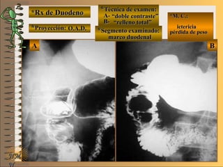 *Rx de Duodeno*Rx de Duodeno
**Proyección:Proyección:
**Técnica de examen:Técnica de examen:
A-A-
B-B-
**Segmento examinado:Segmento examinado:
NMNM
N
E ME M
UNTUNT
*M. C.:*M. C.:
ictericiaictericia
pérdida de pesopérdida de peso
BBAA
O.A.D.O.A.D.
““doble contraste”doble contraste”
““relleno total”relleno total”
marco duodenalmarco duodenal
 