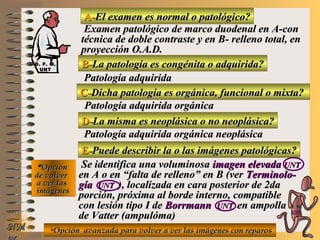 A-A-El examen es normal o patológico?El examen es normal o patológico?
Examen patológico de marco duodenal en A-conExamen patológico de marco duodenal en A-con
técnica de doble contraste y en B- relleno total, entécnica de doble contraste y en B- relleno total, en
proyección O.A.D.proyección O.A.D.
B-B-La patología es congénita o adquirida?La patología es congénita o adquirida?
Patología adquiridaPatología adquirida
D-D-La misma es neoplásica o no neoplásica?La misma es neoplásica o no neoplásica?
**OpciónOpción
de volverde volver
a ver lasa ver las
imágenesimágenes
Patología adquirida orgánica neoplásicaPatología adquirida orgánica neoplásica
E-E-Puede describir la o las imágenes patológicas?Puede describir la o las imágenes patológicas?
Se identifica una voluminosaSe identifica una voluminosa imagen elevadaimagen elevada UNTUNT
en A o en “falta de relleno” en B (veren A o en “falta de relleno” en B (ver Terminolo-Terminolo-
gíagía UNTUNT ), localizada en cara posterior de 2da), localizada en cara posterior de 2da
porción, próxima al borde interno, compatibleporción, próxima al borde interno, compatible
con lesión tipo I decon lesión tipo I de BorrmannBorrmann UNTUNT en ampollaen ampolla
de Vatter (ampulóma)de Vatter (ampulóma)
NMNM
C-C-Dicha patología es orgánica, funcional o mixta?Dicha patología es orgánica, funcional o mixta?
Patología adquirida orgánicaPatología adquirida orgánica
**Opción avanzada para volver a ver las imágenes con reparosOpción avanzada para volver a ver las imágenes con reparos
D. F. M.D. F. M.
UNTUNT
E ME M
UNTUNT
 