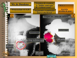 *Rx de Duodeno*Rx de Duodeno
**Proyección: O.A.D.Proyección: O.A.D.
**Técnica de examen:Técnica de examen:
A-“doble contraste”A-“doble contraste”
B- “relleno total”B- “relleno total”
**Segmento examinado:Segmento examinado:
marco duodenalmarco duodenal
NMNM
N
E ME M
UNTUNT
*M. C.:*M. C.:
ictericiaictericia
pérdida de pesopérdida de peso
BBAA imagen elevadaimagen elevada imagen en “falta de relleno”imagen en “falta de relleno”
estómagoestómago
estómagoestómago
22dada
porciónporción
22dada
porciónporción
33rara
porciónporción
33rara
porciónporción
volvervolver
la misma imagenla misma imagen
tipo Borrrmann Itipo Borrrmann I
 