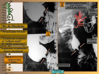 BB
AA
E ME M
UNTUNT
*Rx de Duodeno*Rx de Duodeno
**Proyección: O.A.D.Proyección: O.A.D.
**Técnica de examen:Técnica de examen:
A-“relleno total”A-“relleno total”
B-“doble contraste”B-“doble contraste”
**Segmento examinado:Segmento examinado:
marco duodenalmarco duodenal
*M. C.:*M. C.:
epigastralgiaepigastralgia
vómitovómito
NMNM
bulbo deformadobulbo deformado
con úlceracon úlcera
(H1/2 de Sakita)(H1/2 de Sakita)
estenosisestenosis
volvervolver
estó-estó-
magomago
22dada
porciónporción
 