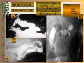 *Rx de Duodeno*Rx de Duodeno
**Proyección:Proyección:
**Técnica de examen:Técnica de examen:
A-A-
BB1/ 21/ 2--
**Segmento examinado:Segmento examinado:
NMNM
N
E ME M
UNTUNT
*M. C.:*M. C.:
dolordolor
vómitovómito
melenamelena
BB22
AA
BB11
O.A.D.O.A.D.
““relleno total”relleno total”
““doble contraste”doble contraste”
bulbo duodenalbulbo duodenal
 
