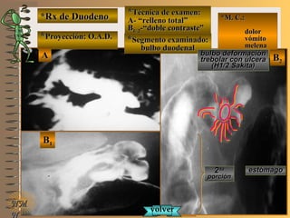 *Rx de Duodeno*Rx de Duodeno
**Proyección: O.A.D.Proyección: O.A.D.
**Técnica de examen:Técnica de examen:
A- “relleno total”A- “relleno total”
BB1/ 21/ 2-“doble contraste”-“doble contraste”
**Segmento examinado:Segmento examinado:
bulbo duodenalbulbo duodenal
NMNM
N
E ME M
UNTUNT
*M. C.:*M. C.:
dolordolor
vómitovómito
melenamelena
BB22
AA
BB11
bulbo deformaciónbulbo deformación
trebolar con úlceratrebolar con úlcera
(H1/2 Sakita)(H1/2 Sakita)
estómagoestómago22dada
porciónporción
volvervolver
 