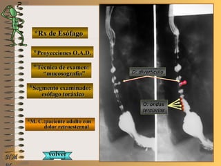 E ME M
UNTUNT
NMNM
*Rx de Esófago*Rx de Esófago
**Proyecciones O.A.D.Proyecciones O.A.D.
**Técnica de examen:Técnica de examen:
““mucosografía”mucosografía”
**Segmento examinado:Segmento examinado:
esófago toráxicoesófago toráxico
*M. C.:paciente adulto con*M. C.:paciente adulto con
dolor retroesternaldolor retroesternal
O: ondasO: ondas
terciariasterciarias
D: divertículoD: divertículo
volvervolver
 