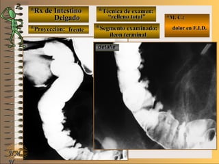 *Rx de Intestino*Rx de Intestino
DelgadoDelgado
**Proyección:Proyección:
**Técnica de examen:Técnica de examen:
**Segmento examinado:Segmento examinado:
NMNM
N
E ME M
UNTUNT
*M. C.:*M. C.:
dolor en F.I.D.dolor en F.I.D.
detalledetalle
frentefrente
““relleno total”relleno total”
ileon terminalileon terminal
 