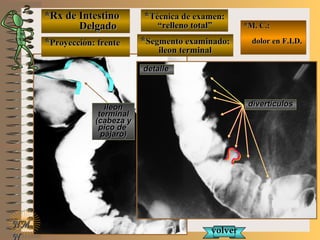 *Rx de Intestino*Rx de Intestino
DelgadoDelgado
**Proyección: frenteProyección: frente
**Técnica de examen:Técnica de examen:
““relleno total”relleno total”
**Segmento examinado:Segmento examinado:
ileon terminalileon terminal
NMNM
N
E ME M
UNTUNT
*M. C.:*M. C.:
dolor en F.I.D.dolor en F.I.D.
detalledetalle
divertículosdivertículos
volvervolver
ileonileon
terminalterminal
(cabeza y(cabeza y
pico depico de
pájaro)pájaro)
 