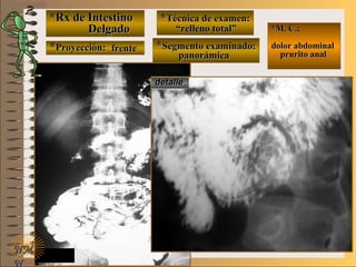*Rx de Intestino*Rx de Intestino
DelgadoDelgado
**Proyección:Proyección:
**Técnica de examen:Técnica de examen:
**Segmento examinado:Segmento examinado:
NMNM
N
E ME M
UNTUNT
*M. C.:*M. C.:
dolor abdominaldolor abdominal
prurito analprurito anal
detalledetalle
frentefrente
““relleno total”relleno total”
panorámicapanorámica
 