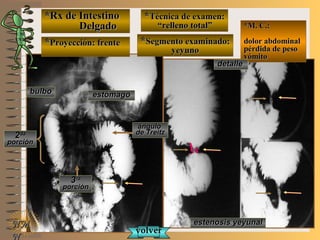 *Rx de Intestino*Rx de Intestino
DelgadoDelgado
**Proyección: frenteProyección: frente
**Técnica de examen:Técnica de examen:
““relleno total”relleno total”
**Segmento examinado:Segmento examinado:
yeyunoyeyuno
NMNM
N
E ME M
UNTUNT
*M. C.:*M. C.:
dolor abdominaldolor abdominal
pérdida de pesopérdida de peso
vómitovómito
bulbobulbo estómagoestómago
22dada
porciónporción
33rara
porciónporción
ánguloángulo
de Treitzde Treitz
estenosis yeyunalestenosis yeyunal
volvervolver
detalledetalle
 
