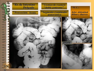 *Rx de Intestino*Rx de Intestino
DelgadoDelgado
**Proyección:Proyección:
**Técnica de examen:Técnica de examen:
**Segmento examinado:Segmento examinado:
NMNM
N
E ME M
UNTUNT
*M. C.:*M. C.:
dolor abdominaldolor abdominal
difuso y diarreadifuso y diarrea
detalledetalle
frentefrente
““doble contraste”doble contraste”
panorámicapanorámica
 