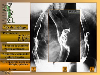 E ME M
UNTUNT
NMNM
*Rx de Esófago*Rx de Esófago
**Proyecciones:Proyecciones:
A-A-
B-B-
C-C-
**Técnica de examen:Técnica de examen:
**Segmento examinado:Segmento examinado:
*M. C.:paciente adulto con*M. C.:paciente adulto con
disfagia y pérdidadisfagia y pérdida
de pesode peso
detalledetalle
AA BB CC
O.A.D.O.A.D.
FrenteFrente
O.A.I.O.A.I.
““doble contraste”doble contraste”
esófago toráxicoesófago toráxico
 