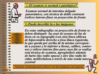 A-A-El examen es normal o patológico?El examen es normal o patológico?
Examen normal de intestino delgadoExamen normal de intestino delgado
panorámico, con técnica de doble contrastepanorámico, con técnica de doble contraste
(relieve interno fino)(relieve interno fino) en proyección de frenteen proyección de frente
B-B-Puede describir la o las imágenesPuede describir la o las imágenes
**OpciónOpción
de volverde volver
a ver lasa ver las
imágenesimágenes
En estas radiografías en proyección de frente seEn estas radiografías en proyección de frente se
deben distinguir las asas de yeyuno de las dedeben distinguir las asas de yeyuno de las de
ileon en su topografía (con una línea oblicuaileon en su topografía (con una línea oblicua
de hipocondrio derecho a fosa ilíaca izquierda,de hipocondrio derecho a fosa ilíaca izquierda,
lo que queda por arriba de la misma correspon-lo que queda por arriba de la misma correspon-
de a yeyuno y lo inferior a ileon), calibre, contor-de a yeyuno y lo inferior a ileon), calibre, contor-
nos y relieve interno fino para cuyo fin se realizanos y relieve interno fino para cuyo fin se realiza
esta técnica de examen, agregándose ademásesta técnica de examen, agregándose además
de bario (faz radio opaca) y aire (faz radio lú-de bario (faz radio opaca) y aire (faz radio lú-
cida), metilcelulosa a través de una sonda naso-cida), metilcelulosa a través de una sonda naso-
yeyunalyeyunal
**Opción avanzada para volver a ver las imágenes con reparosOpción avanzada para volver a ver las imágenes con reparos
NMNM
D. F. M.D. F. M.
UNTUNT
E ME M
UNTUNT
 