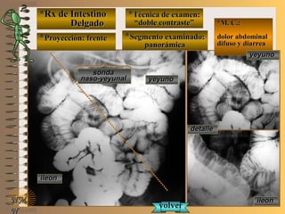 *Rx de Intestino*Rx de Intestino
DelgadoDelgado
**Proyección: frenteProyección: frente
**Técnica de examen:Técnica de examen:
““doble contraste”doble contraste”
**Segmento examinado:Segmento examinado:
panorámicapanorámica
NMNM
N
E ME M
UNTUNT
*M. C.:*M. C.:
dolor abdominaldolor abdominal
difuso y diarreadifuso y diarrea
detalledetalle
yeyunoyeyuno
yeyunoyeyuno
ileonileon
ileonileon
volvervolver
sondasonda
naso-yeyunalnaso-yeyunal
 