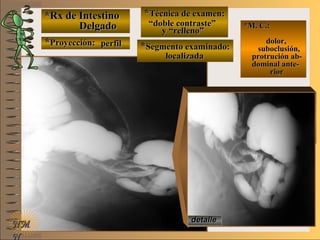*Rx de Intestino*Rx de Intestino
DelgadoDelgado
**Proyección:Proyección:
**Técnica de examen:Técnica de examen:
**Segmento examinado:Segmento examinado:
E ME M
UNTUNT
*M. C.:*M. C.:
dolor,dolor,
suboclusión,suboclusión,
protrución ab-protrución ab-
dominal ante-dominal ante-
riorrior
NMNM
N
detalledetalle
perfilperfil
““doble contraste”doble contraste”
y “relleno”y “relleno”
localizadalocalizada
 