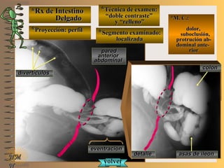 *Rx de Intestino*Rx de Intestino
DelgadoDelgado
**Proyección: perfilProyección: perfil
**Técnica de examen:Técnica de examen:
““doble contraste”doble contraste”
y “relleno”y “relleno”
**Segmento examinado:Segmento examinado:
localizadalocalizada
E ME M
UNTUNT
*M. C.:*M. C.:
dolor,dolor,
suboclusión,suboclusión,
protrución ab-protrución ab-
dominal ante-dominal ante-
riorrior
NMNM
N
detalledetalle asas de ileonasas de ileon
coloncolon
paredpared
anterioranterior
abdominalabdominal
eventracióneventración
volvervolver
divertículosdivertículos
 