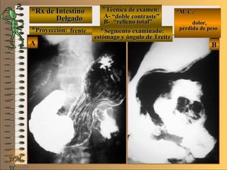*Rx de Intestino*Rx de Intestino
DelgadoDelgado
**Proyección:Proyección:
**Técnica de examen:Técnica de examen:
A-A-
B-B-
**Segmento examinado:Segmento examinado:
E ME M
UNTUNT
*M. C.:*M. C.:
dolor,dolor,
pérdida de pesopérdida de peso
NMNM
N
BBAA
frentefrente
““doble contraste”doble contraste”
““relleno total”relleno total”
estómago y ángulo de Treitzestómago y ángulo de Treitz
 