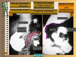 *Rx de Intestino*Rx de Intestino
DelgadoDelgado
**Proyección: frenteProyección: frente
**Técnica de examen:Técnica de examen:
A-“doble contraste”A-“doble contraste”
B-“relleno total”B-“relleno total”
**Segmento examinado:Segmento examinado:
estómago y ángulo de Treitzestómago y ángulo de Treitz
E ME M
UNTUNT
*M. C.:*M. C.:
dolor,dolor,
pérdida de pesopérdida de peso
NMNM
N
BBAA
estómagoestómago
ánguloángulo
de Treitzde Treitz
estómagoestómago
ánguloángulo
de Treitzde Treitz
masamasa
masamasa
plieguespliegues
gástricosgástricos
en puenteen puente
volvervolver
 