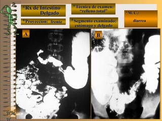 *Rx de Intestino*Rx de Intestino
DelgadoDelgado
**Proyección:Proyección:
**Técnica de examen:Técnica de examen:
**Segmento examinado:Segmento examinado:
E ME M
UNTUNT
*M. C.:*M. C.:
diarreadiarrea
NMNM
N
BBAA
frentefrente
““relleno total”relleno total”
estómago y delgadoestómago y delgado
 
