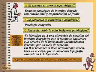 A-A-El examen es normal o patológico?El examen es normal o patológico?
Examen patológico de intestino delgadoExamen patológico de intestino delgado
con relleno total y en proyección de frentecon relleno total y en proyección de frente
B-B-La patología es congénita o adquirida?La patología es congénita o adquirida?
Patología congénitaPatología congénita
C-C-Puede describir la o las imágenes patológicas?Puede describir la o las imágenes patológicas?
**OpciónOpción
de volverde volver
a ver lasa ver las
imágenesimágenes
Se identifica en A una alteración de posición delSe identifica en A una alteración de posición del
intestino delgado ya que el mismo se encuentraintestino delgado ya que el mismo se encuentra
a la derecha de la línea media (hemiabdomena la derecha de la línea media (hemiabdomen
derecho) por un vicio de rotación.derecho) por un vicio de rotación.
En B se reconoce el ileon terminal que desem-En B se reconoce el ileon terminal que desem-
boca en el ciego, que se encuentra topográfi-boca en el ciego, que se encuentra topográfi-
camente en F.I. Izquierda.camente en F.I. Izquierda.
**Opción avanzada para volver a ver las imágenes con reparosOpción avanzada para volver a ver las imágenes con reparos
NMNM
D. F. M.D. F. M.
UNTUNT
E ME M
UNTUNT
 