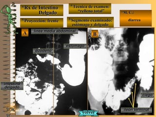 *Rx de Intestino*Rx de Intestino
DelgadoDelgado
**Proyección: frenteProyección: frente
**Técnica de examen:Técnica de examen:
““relleno total”relleno total”
**Segmento examinado:Segmento examinado:
estómago y delgadoestómago y delgado
E ME M
UNTUNT
*M. C.:*M. C.:
diarreadiarrea
NMNM
N
BBAA línea media abdominallínea media abdominal
estómagoestómago
duodenoduodeno
intestinointestino
delgadodelgado
ileon terminalileon terminal
ciegociego
volvervolver
 