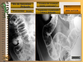 *Rx de Intestino*Rx de Intestino
DelgadoDelgado
**Proyección:Proyección:
**Técnica de examen:Técnica de examen:
**Segmento examinado:Segmento examinado:
E ME M
UNTUNT
*M. C.:*M. C.:
dolor en F.I.D.dolor en F.I.D.
NMNM
N
detalledetalle
frentefrente
““doble contraste”doble contraste”
colon y delgadocolon y delgado
 