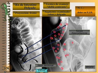 *Rx de Intestino*Rx de Intestino
DelgadoDelgado
**Proyección: frenteProyección: frente
**Técnica de examen:Técnica de examen:
““doble contraste”doble contraste”
**Segmento examinado:Segmento examinado:
colon y delgadocolon y delgado
E ME M
UNTUNT
*M. C.:*M. C.:
dolor en F.I.D.dolor en F.I.D.
NMNM
N
ileon terminalileon terminal
focosfocos
hiperplásicoshiperplásicos
volvervolver
detalledetalle
 
