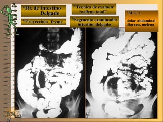 *Rx de Intestino*Rx de Intestino
DelgadoDelgado
**Proyección:Proyección:
**Técnica de examen:Técnica de examen:
**Segmento examinado:Segmento examinado:
E ME M
UNTUNT
*M. C.:*M. C.:
dolor abdominaldolor abdominal
diarrea, melenadiarrea, melena
NMNM
N
frentefrente
““relleno total”relleno total”
intestino delgadointestino delgado
 