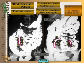 *Rx de Intestino*Rx de Intestino
DelgadoDelgado
**Proyección: frenteProyección: frente
**Técnica de examen:Técnica de examen:
““relleno total”relleno total”
**Segmento examinado:Segmento examinado:
intestino delgadointestino delgado
E ME M
UNTUNT
*M. C.:*M. C.:
dolor abdominaldolor abdominal
diarrea, melenadiarrea, melena
NMNM
N
estenosisestenosis
““ventanas”ventanas”
volvervolver
 