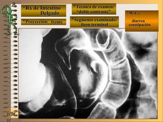 *Rx de Intestino*Rx de Intestino
DelgadoDelgado
**Proyección:Proyección:
**Técnica de examen:Técnica de examen:
**Segmento examinado:Segmento examinado:
E ME M
UNTUNT
*M. C.:*M. C.:
diarreadiarrea
constipaciónconstipación
NMNM
N
frentefrente
““doble contraste”doble contraste”
ileon terminalileon terminal
 