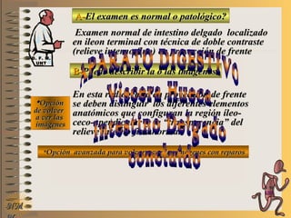 A-A-El examen es normal o patológico?El examen es normal o patológico?
Examen normal de intestino delgado localizadoExamen normal de intestino delgado localizado
en ileon terminal con técnica de doble contrasteen ileon terminal con técnica de doble contraste
(relieve interno fino)(relieve interno fino) en proyección de frenteen proyección de frente
B-B-Puede describir la o las imágenesPuede describir la o las imágenes
**OpciónOpción
de volverde volver
a ver lasa ver las
imágenesimágenes
En esta radiografía en proyección de frenteEn esta radiografía en proyección de frente
se deben distinguir los diferentes elementosse deben distinguir los diferentes elementos
anatómicos que configuran la región íleo-anatómicos que configuran la región íleo-
ceco-apendicular y la “transparencia” delceco-apendicular y la “transparencia” del
relieve interno fino normalrelieve interno fino normal
**Opción avanzada para volver a ver las imágenes con reparosOpción avanzada para volver a ver las imágenes con reparos
NMNM
D. F. M.D. F. M.
UNTUNT
E ME M
UNTUNT
 