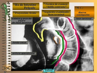 *Rx de Intestino*Rx de Intestino
DelgadoDelgado
**Proyección: frenteProyección: frente
**Técnica de examen:Técnica de examen:
““doble contraste”doble contraste”
**Segmento examinado:Segmento examinado:
ileon terminalileon terminal
E ME M
UNTUNT
*M. C.:*M. C.:
diarreadiarrea
constipaciónconstipación
NMNM
N
ileon terminalileon terminalcabeza y pico decabeza y pico de
pájaropájaro
de ileon terminalde ileon terminal
fondo cecalfondo cecal
orificio apendicularorificio apendicular
volvervolver
 