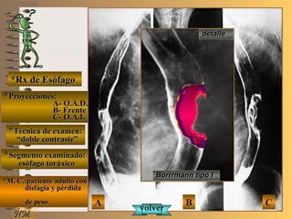 E ME M
UNTUNT
NMNM
*Rx de Esófago*Rx de Esófago
**Proyecciones:Proyecciones:
A- O.A.D.A- O.A.D.
B- FrenteB- Frente
C- O.A.I.C- O.A.I.
**Técnica de examen:Técnica de examen:
““doble contraste”doble contraste”
**Segmento examinado:Segmento examinado:
esófago toráxicoesófago toráxico
*M. C.:paciente adulto con*M. C.:paciente adulto con
disfagia y pérdidadisfagia y pérdida
de pesode peso
detalledetalle
AA BB CC
volvervolver
Borrrmann tipo IBorrrmann tipo I
 