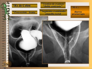 *Rx de Colon*Rx de Colon
**Proyección:Proyección:
**Técnica de examen:Técnica de examen:
**Segmento examinado:Segmento examinado:
E ME M
UNTUNT
*M. C.:*M. C.:
diarreadiarrea
proctorragiaproctorragia
NMNM
N
detalledetalle
frentefrente
““doble contraste”doble contraste”
ampolla rectalampolla rectal
 