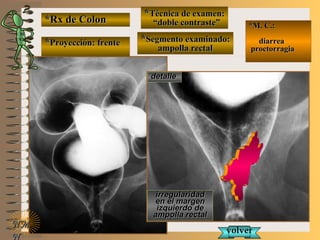 *Rx de Colon*Rx de Colon
**Proyección: frenteProyección: frente
**Técnica de examen:Técnica de examen:
““doble contraste”doble contraste”
**Segmento examinado:Segmento examinado:
ampolla rectalampolla rectal
E ME M
UNTUNT
*M. C.:*M. C.:
diarreadiarrea
proctorragiaproctorragia
NMNM
N
detalledetalle
irregularidadirregularidad
en el margenen el margen
izquierdo deizquierdo de
ampolla rectalampolla rectal
volvervolver
 