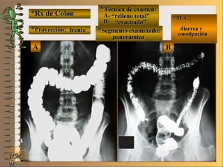 *Rx de Colon*Rx de Colon
**Proyección:Proyección:
**Técnica de examen:Técnica de examen:
A-A-
B-B-
**Segmento examinado:Segmento examinado:
E ME M
UNTUNT
*M. C.:*M. C.:
diarrea ydiarrea y
constipaciónconstipación
NMNM
N
BBAA
frentefrente
““relleno total”relleno total”
““evacuado”evacuado”
panorámicapanorámica
 