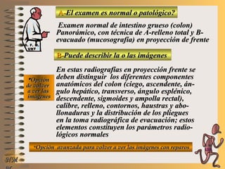 D. F. M.D. F. M.
UNTUNT
A-A-El examen es normal o patológico?El examen es normal o patológico?
Examen normal de intestino grueso (colon)Examen normal de intestino grueso (colon)
Panorámico, con técnica de A-relleno total y B-Panorámico, con técnica de A-relleno total y B-
evacuado (mucosografía)evacuado (mucosografía) en proyección de frenteen proyección de frente
B-B-Puede describir la o las imágenesPuede describir la o las imágenes
**OpciónOpción
de volverde volver
a ver lasa ver las
imágenesimágenes
En estas radiografías en proyección frente seEn estas radiografías en proyección frente se
deben distinguir los diferentes componentesdeben distinguir los diferentes componentes
anatómicos del colon (ciego, ascendente, án-anatómicos del colon (ciego, ascendente, án-
gulo hepático, transverso, ángulo esplénico,gulo hepático, transverso, ángulo esplénico,
descendente, sigdescendente, sigmoides y ampolla rectal),moides y ampolla rectal),
calibre, relleno, contornos, haustras y abo-calibre, relleno, contornos, haustras y abo-
llonaduras y la distribución de los plieguesllonaduras y la distribución de los pliegues
en la toma radiográfica de evacuación; estosen la toma radiográfica de evacuación; estos
elementos constituyen los parámetros radio-elementos constituyen los parámetros radio-
lógicos normaleslógicos normales
**Opción avanzada para volver a ver las imágenes con reparosOpción avanzada para volver a ver las imágenes con reparos
NMNM
E ME M
UNTUNT
 