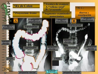 *Rx de Colon*Rx de Colon
**Proyección: frenteProyección: frente
**Técnica de examen:Técnica de examen:
A-“relleno total”A-“relleno total”
B- “evacuado”B- “evacuado”
**Segmento examinado:Segmento examinado:
panorámicapanorámica
E ME M
UNTUNT
*M. C.:*M. C.:
diarrea ydiarrea y
constipaciónconstipación
NMNM
N
ciegociego ciegociego
ascen-ascen-
dentedente
ascen-ascen-
dentedente
ánguloángulo
hepáticohepático
ánguloángulo
hepáticohepático
transversotransverso
transversotransverso
ánguloángulo
esplenicoesplenico
ánguloángulo
esplenicoesplenico
descen-descen-
dentedente
descen-descen-
dentedentesigmoidessigmoides sigmoidessigmoides
ampolla rectalampolla rectal ampolla rectalampolla rectal
volvervolver
BBAA
 