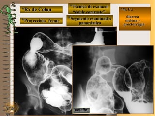 *Rx de Colon*Rx de Colon
**Proyección:Proyección:
**Técnica de examen:Técnica de examen:
**Segmento examinado:Segmento examinado:
E ME M
UNTUNT
*M. C.:*M. C.:
diarrea,diarrea,
melena ymelena y
proctorrágiaproctorrágia
NMNM
N
detalledetalle
frentefrente
““doble contraste”doble contraste”
panorámicapanorámica
 