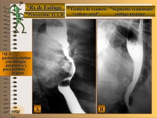 E ME M
UNTUNT
NMNM
*Rx de Esófago*Rx de Esófago
**Proyección:Proyección:
**Técnica de examen:Técnica de examen: **Segmento examinado:Segmento examinado:
*M. C.:*M. C.:
pacientes adultospacientes adultos
con disfagiacon disfagia
progresiva yprogresiva y
poca pérdidapoca pérdida
de pesode peso
AA BB
O.A.D.O.A.D. ““relleno total”relleno total” esófago toráxicoesófago toráxico
 