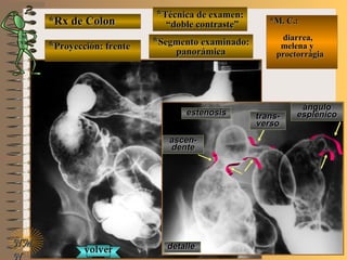 *Rx de Colon*Rx de Colon
**Proyección: frenteProyección: frente
**Técnica de examen:Técnica de examen:
““doble contraste”doble contraste”
**Segmento examinado:Segmento examinado:
panorámicapanorámica
E ME M
UNTUNT
*M. C.:*M. C.:
diarrea,diarrea,
melena ymelena y
proctorrágiaproctorrágia
NMNM
N
detalledetalle
estenosisestenosis
ascen-ascen-
dentedente
trans-trans-
versoverso
ánguloángulo
esplénicoesplénico
volvervolver
 